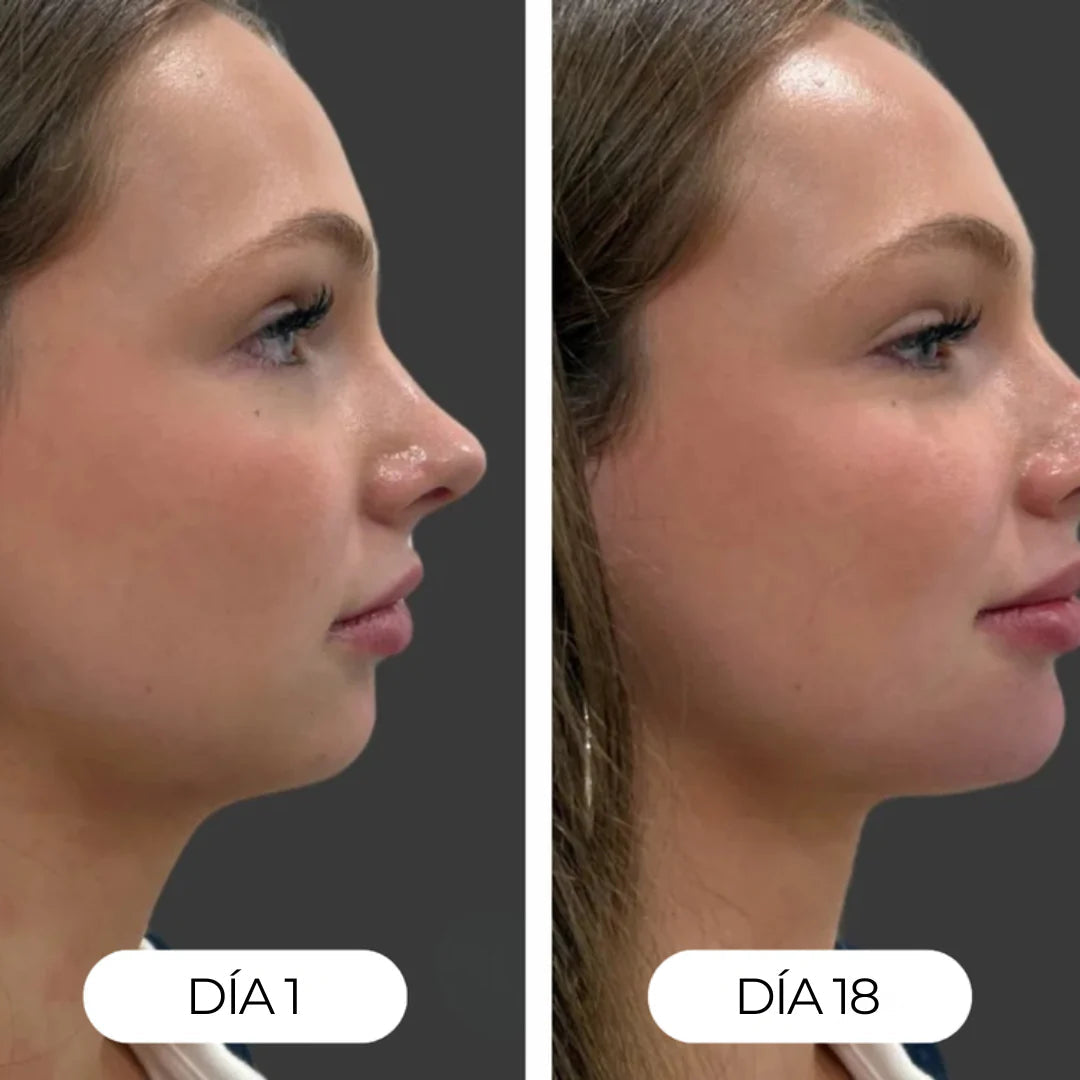 Resultado real rostro antes y despues