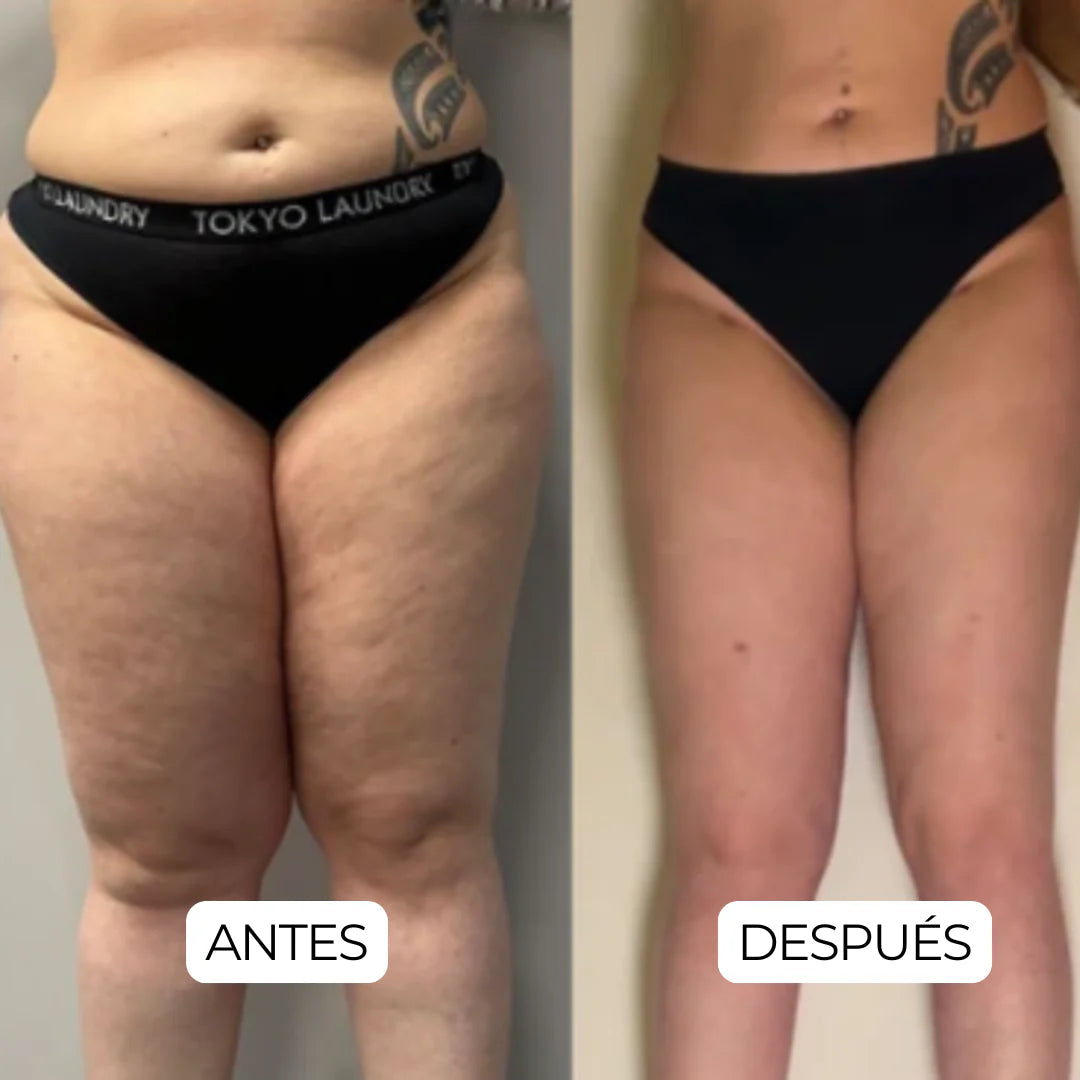 Resultado real pie antes y despues
